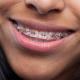 Imagem mostra mulher que sorri com aparelho de dentes
