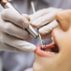 UNG oferece 200 vagas para tratamento odontológico gratuito